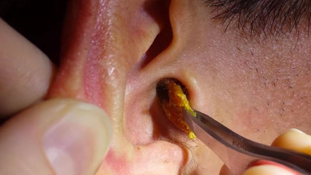 कानातला मळ (Ear Wax) काढण्याचे घरगुती उपाय