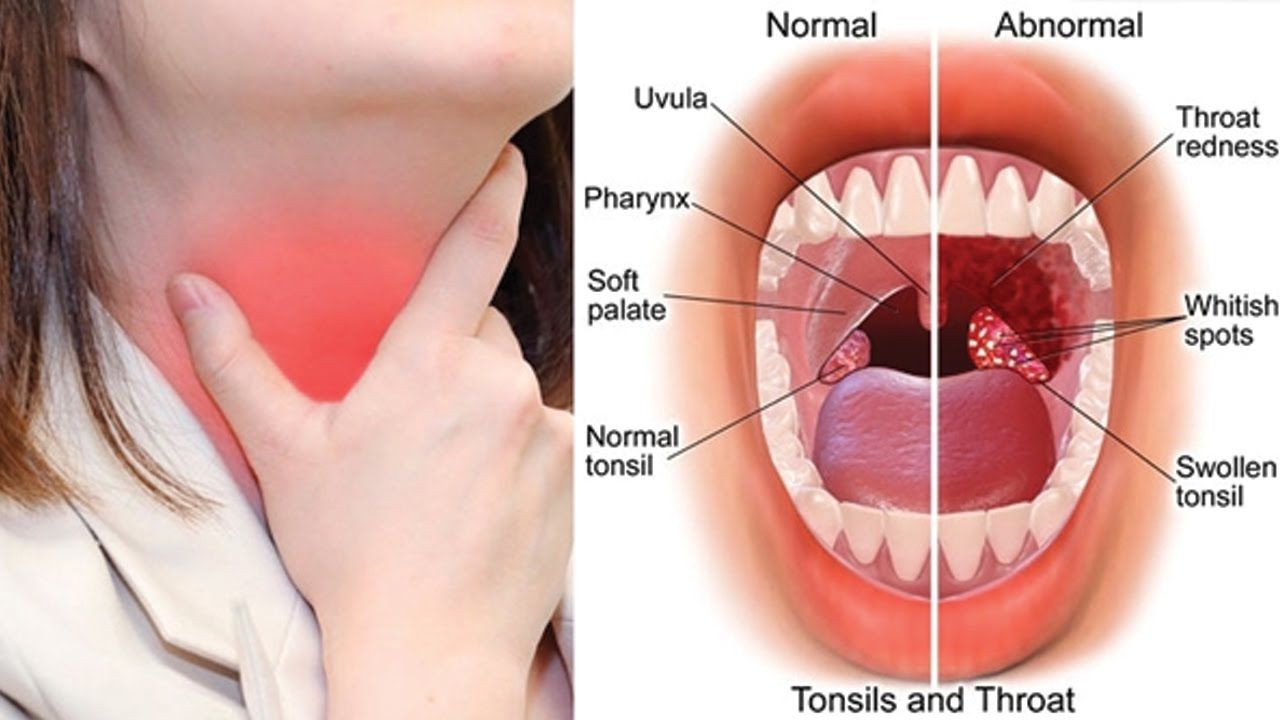 how to take care of tonsillitis at home marathi