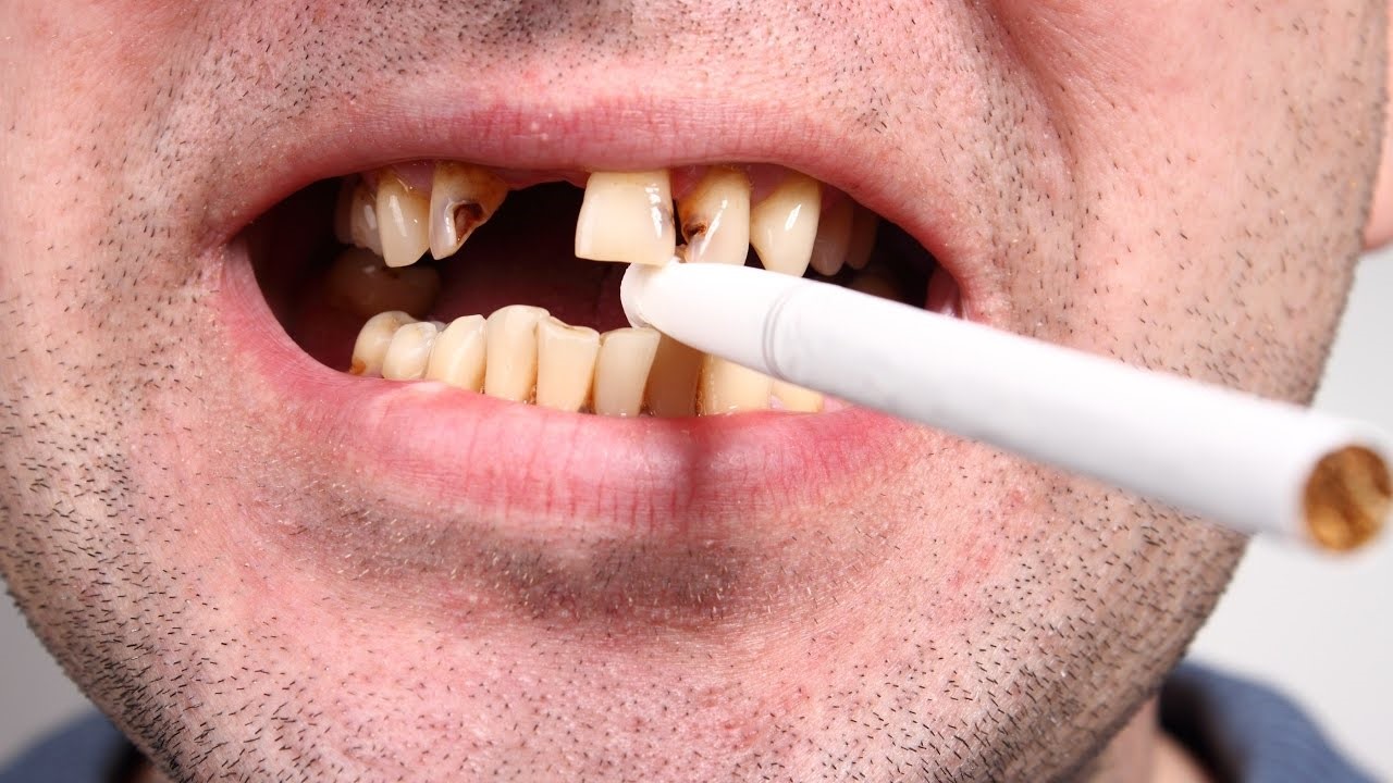 सि_गरेट आणि तोंडाचे आरोग्य सि_गरेटचे व्यसन कसे सोडवावे सि_गरेटमुळे दातांवर पडलेले तंबाखूचे डाग कसे घालवावे