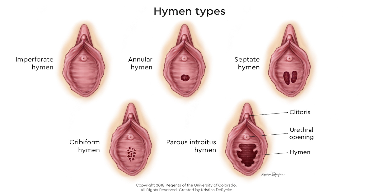 Imperforate hymen in marathi